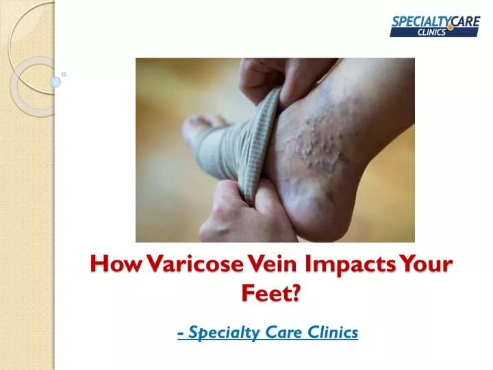 how varicose vein impacts your feet