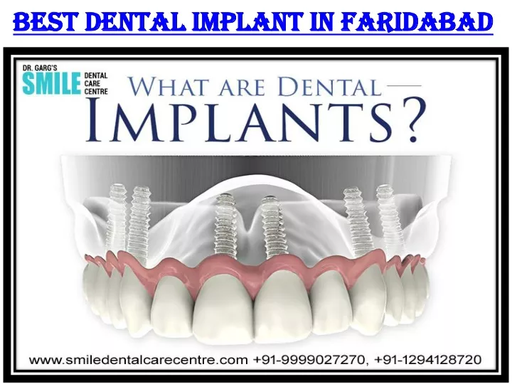 best dental implant in faridabad