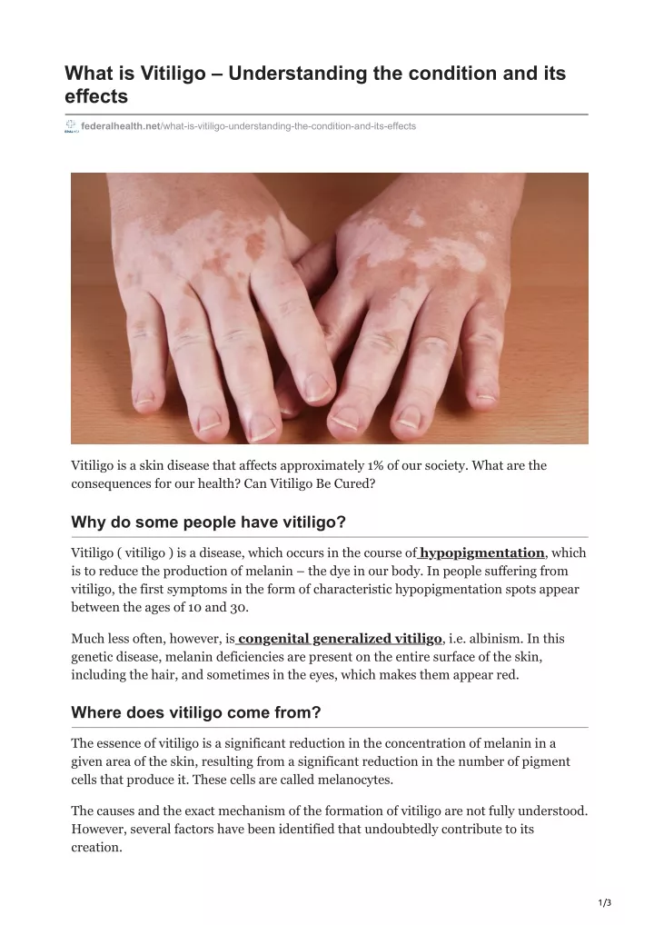what is vitiligo understanding the condition