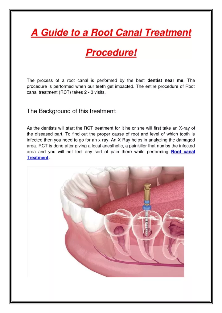 a guide to a root canal treatment