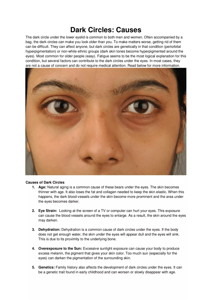 dark circles causes