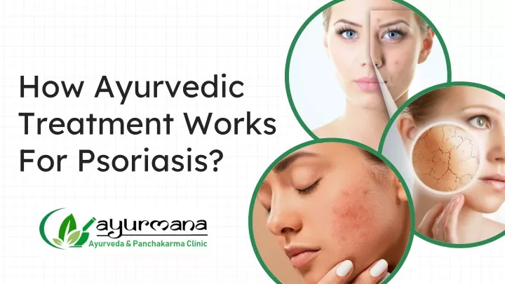 how ayurvedic treatment works for psoriasis