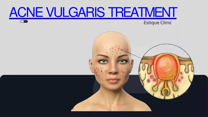 acne vulgaris treatment