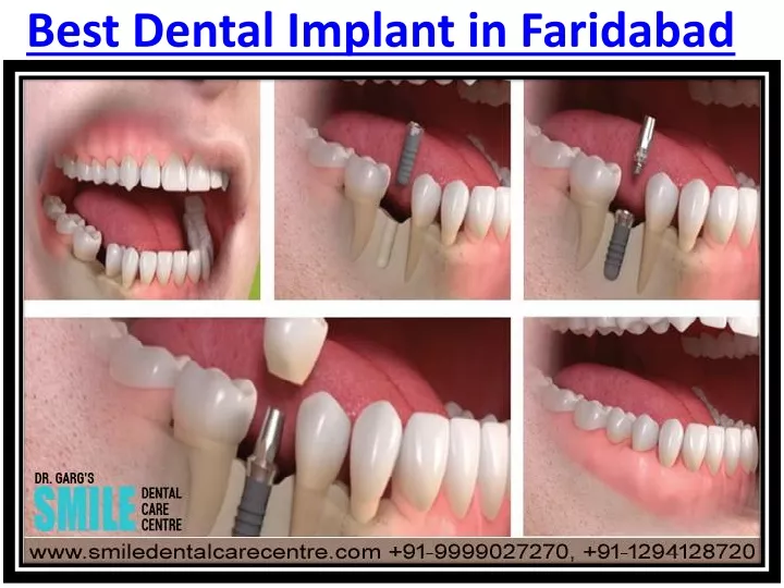 best dental implant in faridabad