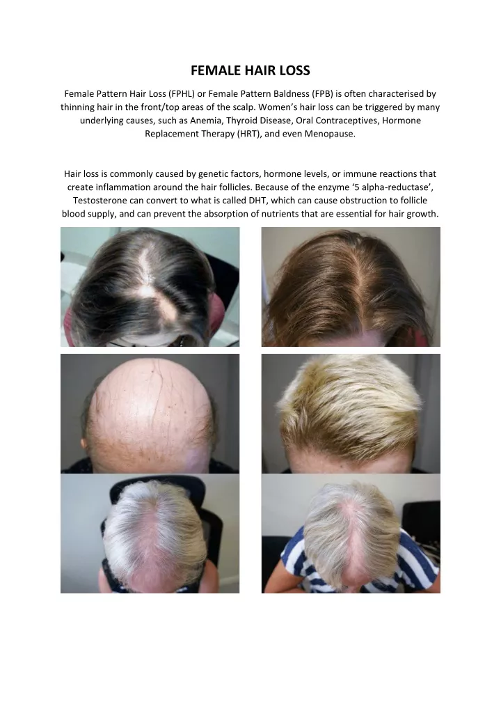 female hair loss