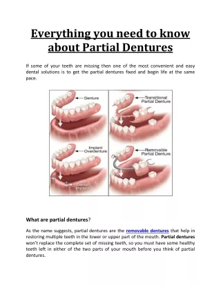 Everything you need to know about Partial Dentures