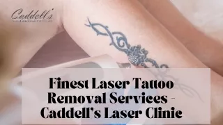 Finest Laser Tattoo Removal Services - Caddell's Laser Clinic