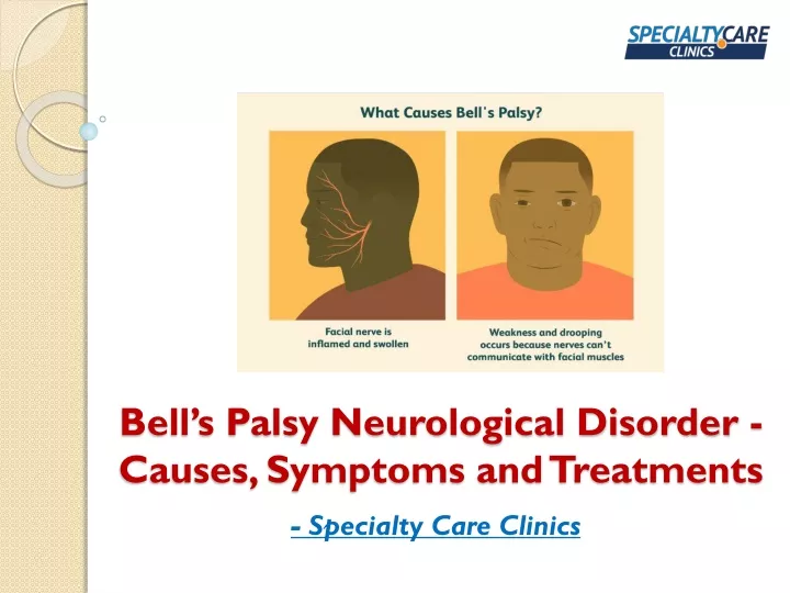 bell s palsy neurological disorder causes symptoms and treatments