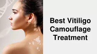 Best Vitiligo Camouflage Treatment