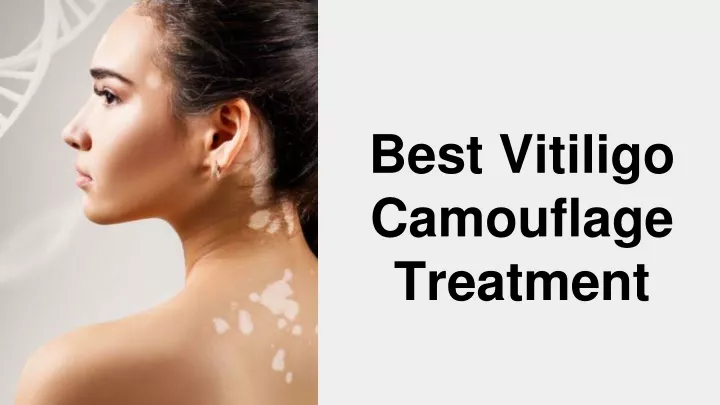 best vitiligo camouflage treatment