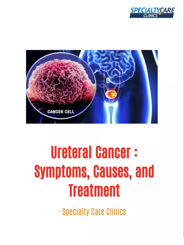 PPT - Ureteral Cancer - Symptoms, Causes, and Treatment PowerPoint ...