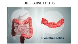 ulcerative colitis