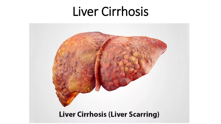 liver cirrhosis