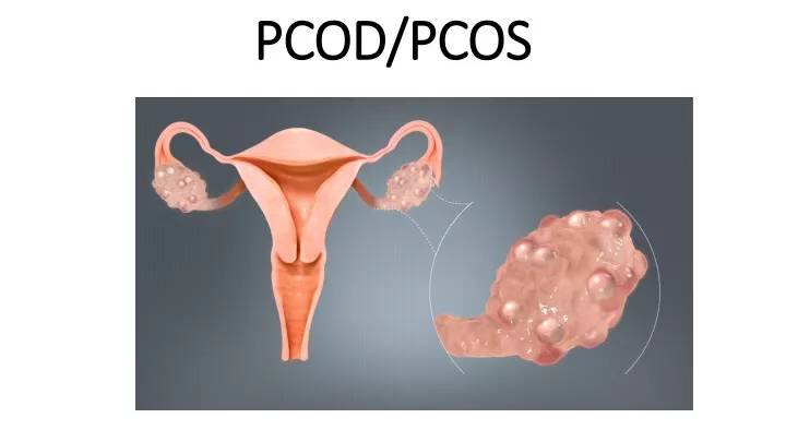 pcod pcos