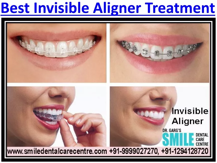 best invisible aligner treatment