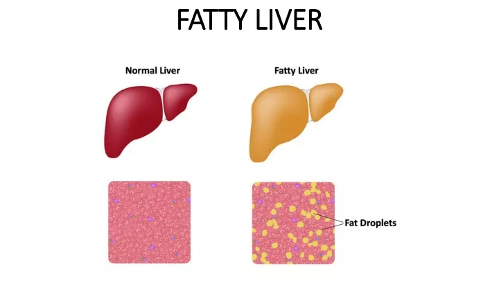 fatty liver