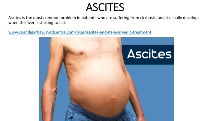 ascites