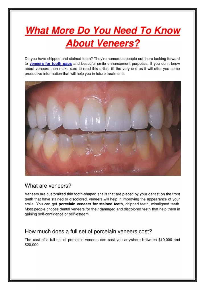 what more do you need to know about veneers