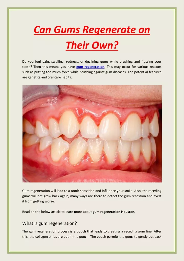 PPT Can Gums Regenerate on Their Own PowerPoint Presentation, free