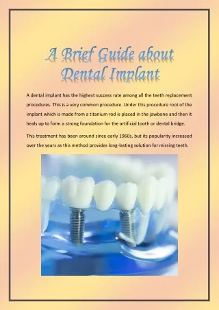 A Brief Guide about Dental Implant