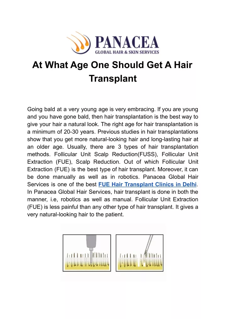 at what age one should get a hair transplant