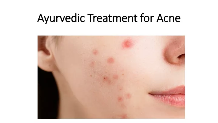 ayurvedic treatment for acne