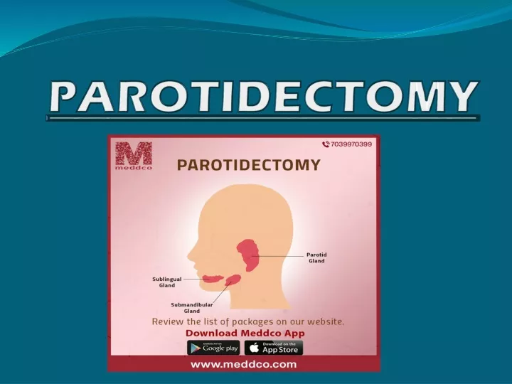 parotidectomy