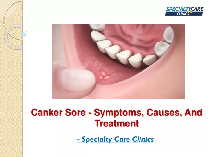 Ppt Canker Sore Symptoms Causes And Treatment Powerpoint Presentation Id11123845 2041