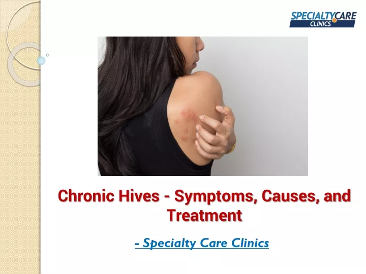 Ppt Chronic Hives Symptoms Causes And Treatment Powerpoint 2954