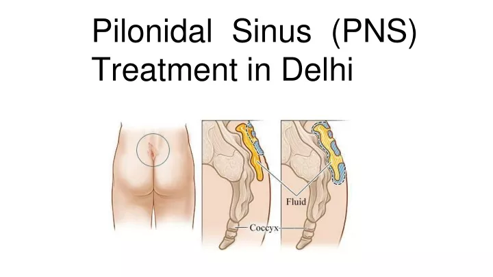 pilonidal sinus pns treatment in delhi