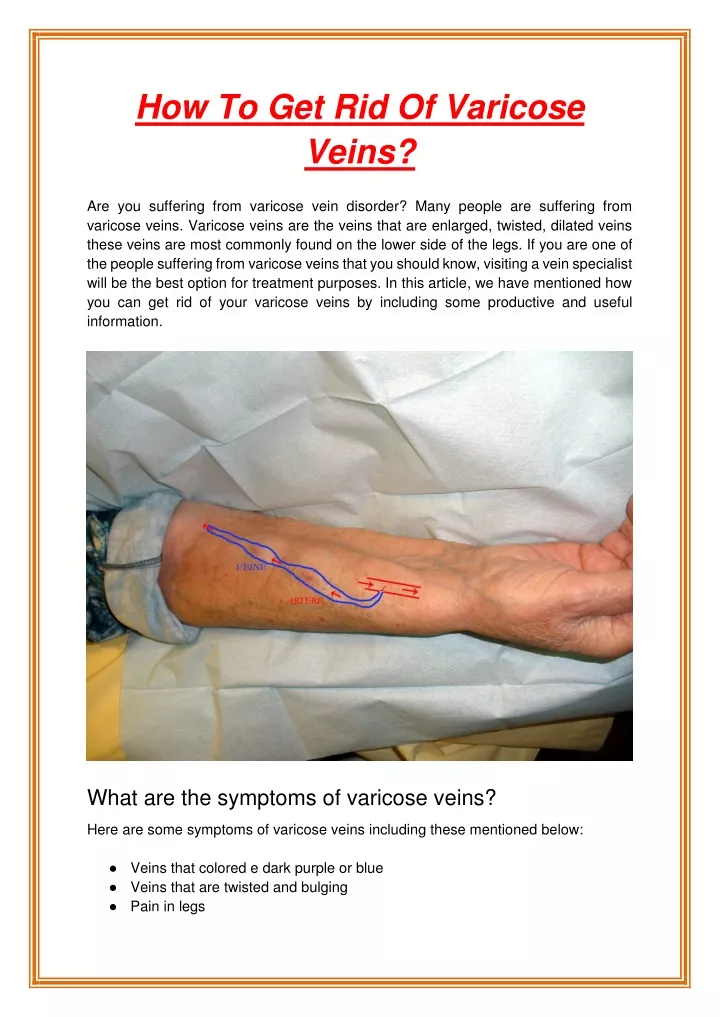 how to get rid of varicose veins