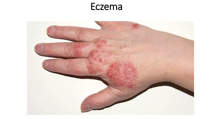 eczema