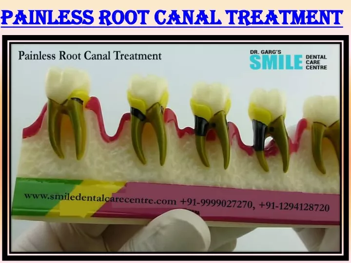 painless root canal treatment