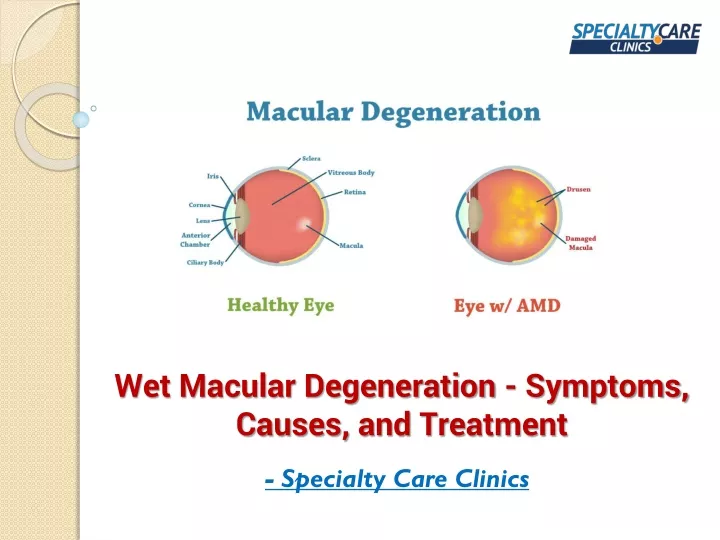 wet macular degeneration symptoms causes and treatment