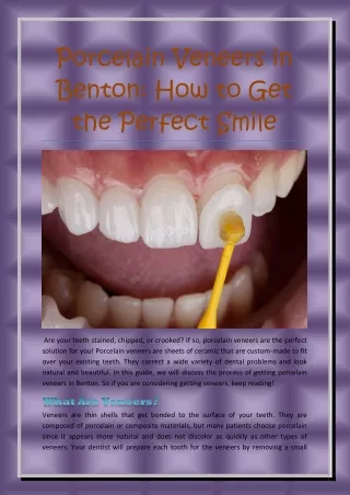 Porcelain Veneers in Benton: How to Get the Perfect Smile