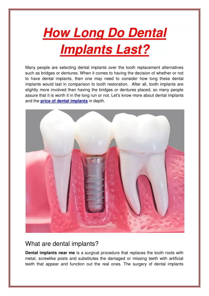 how long do dental implants last