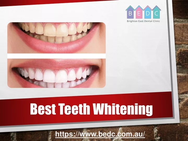 best teeth whitening