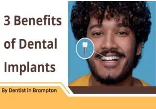 3 Benefits of Dental Implants By Dentist in Brampton