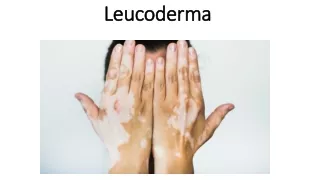 Ayurvedic Treatment for Leucoderma