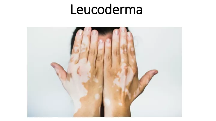 leucoderma