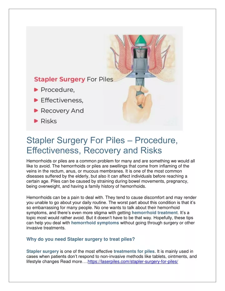 stapler surgery for piles procedure effectiveness