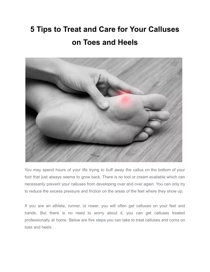 5 tips to treat and care for your calluses