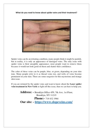 what do you need to know about spider veins