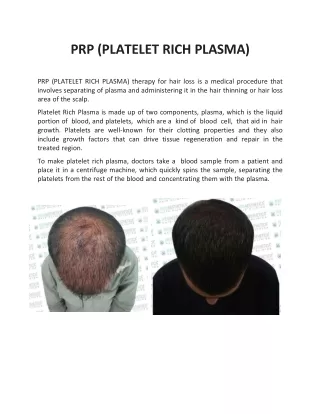 PRP (PLATELET RICH PLASMA)