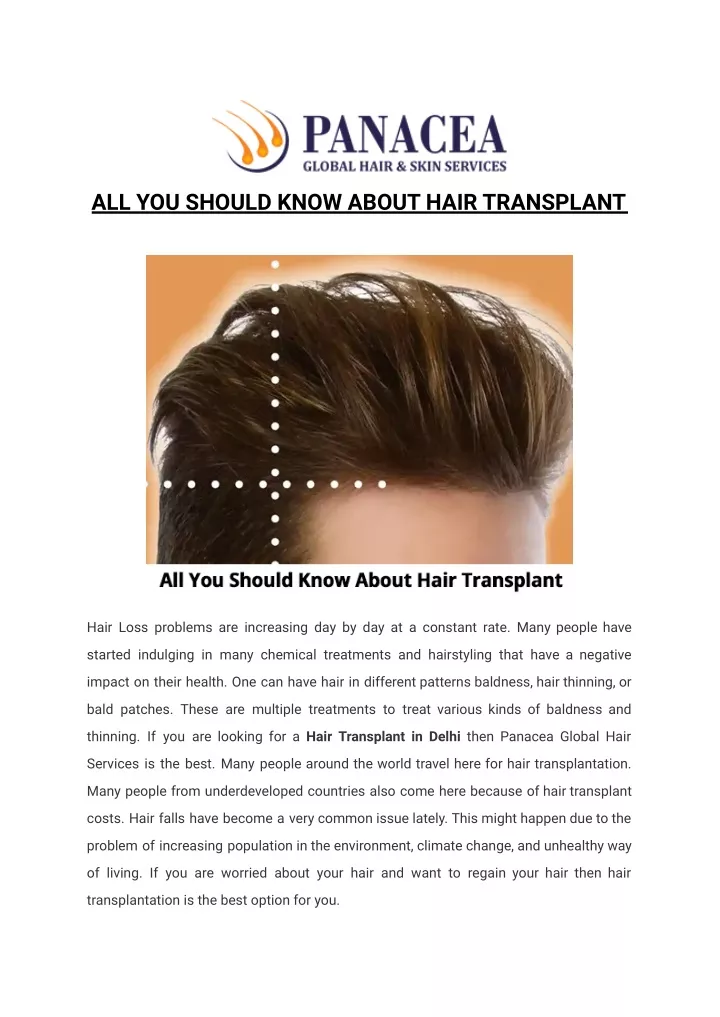 all you should know about hair transplant