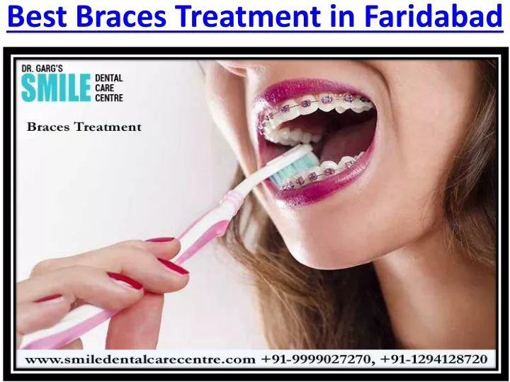 best braces treatment in faridabad