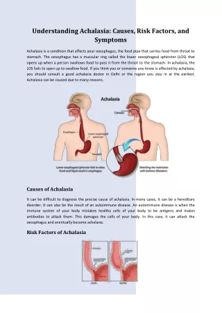 Understanding Achalasia: Causes, Risk Factors, and Symptoms