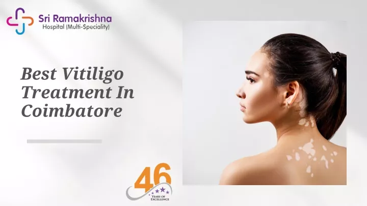 best vitiligo treatment in coimbatore