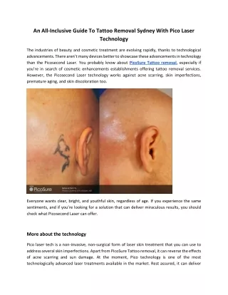 An All-Inclusive Guide To Tattoo Removal Sydney With Pico Laser Technology
