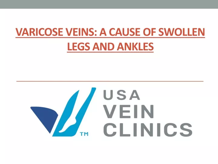 varicose veins a cause of swollen legs and ankles